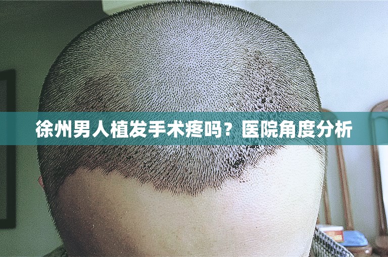 徐州男人植发手术疼吗？医院角度分析