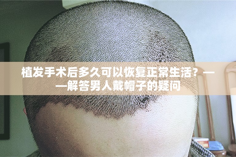 植发手术后多久可以恢复正常生活？——解答男人戴帽子的疑问