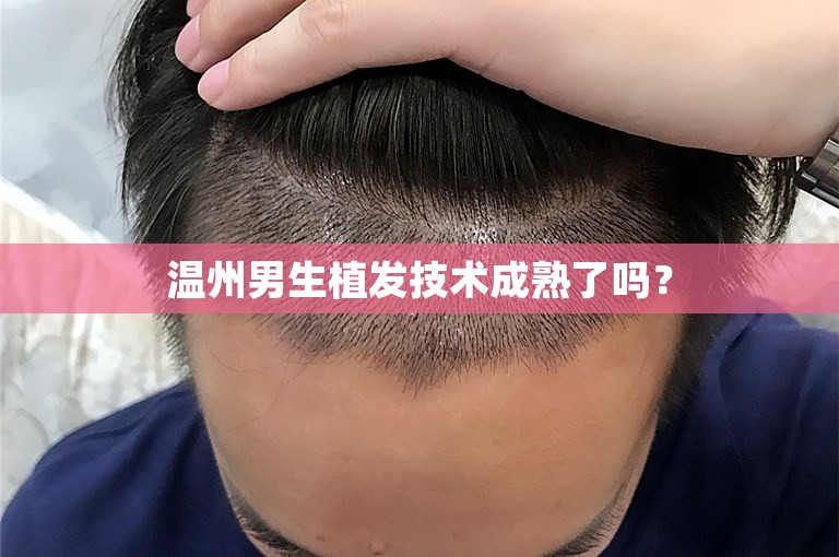 温州男生植发技术成熟了吗？