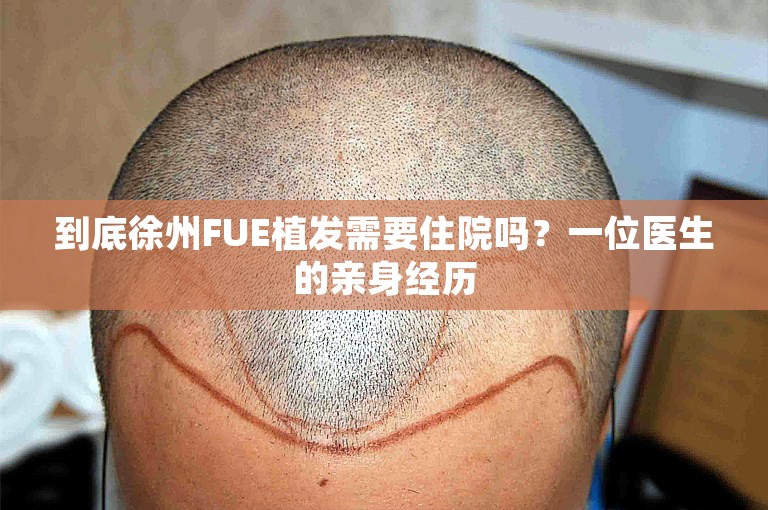 到底徐州FUE植发需要住院吗？一位医生的亲身经历