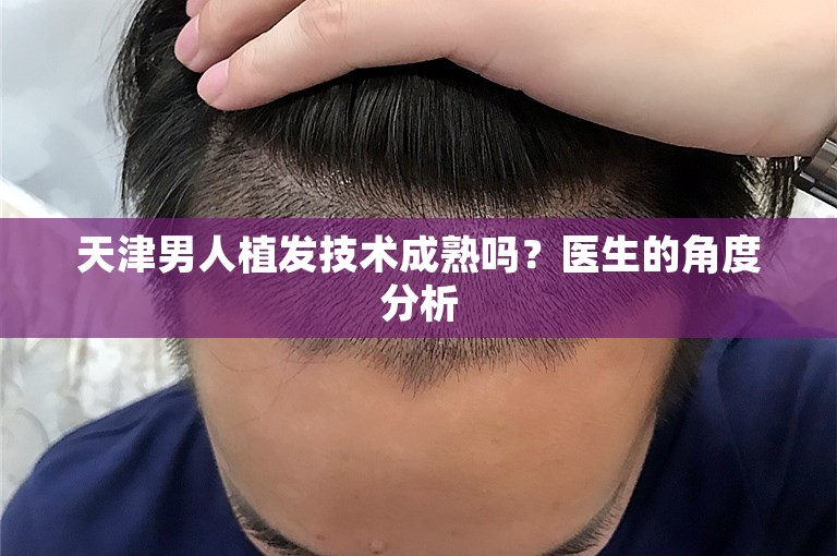 天津男人植发技术成熟吗？医生的角度分析