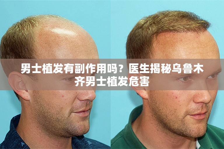 男士植发有副作用吗？医生揭秘乌鲁木齐男士植发危害