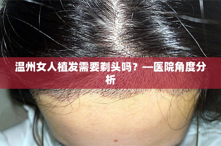 温州女人植发需要剃头吗？—医院角度分析