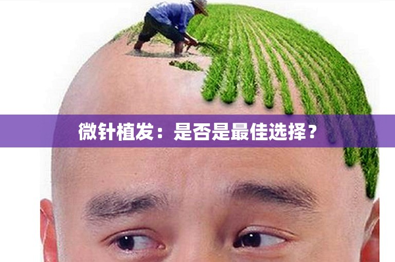 微针植发：是否是最佳选择？