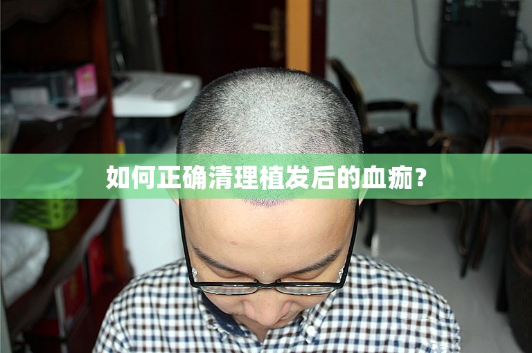 如何正确清理植发后的血痂？