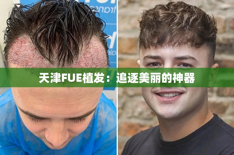 天津FUE植发：追逐美丽的神器