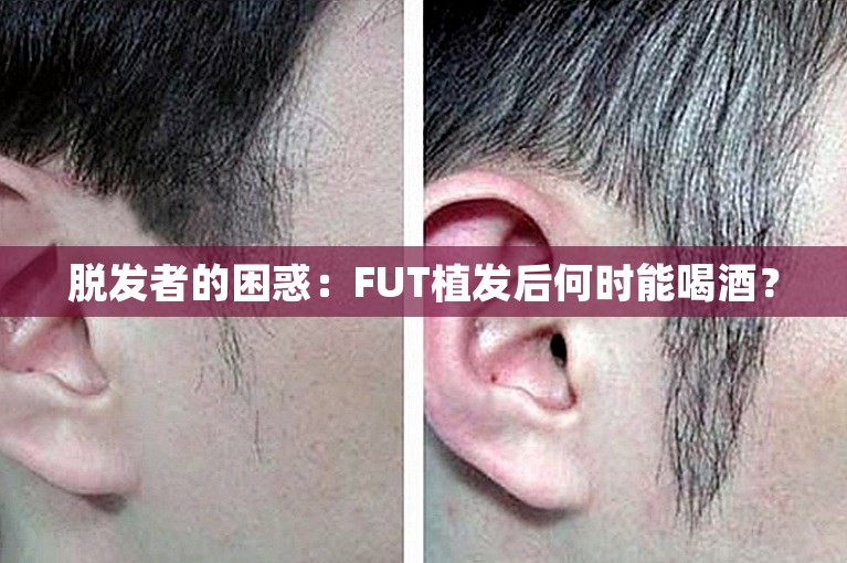 脱发者的困惑：FUT植发后何时能喝酒？