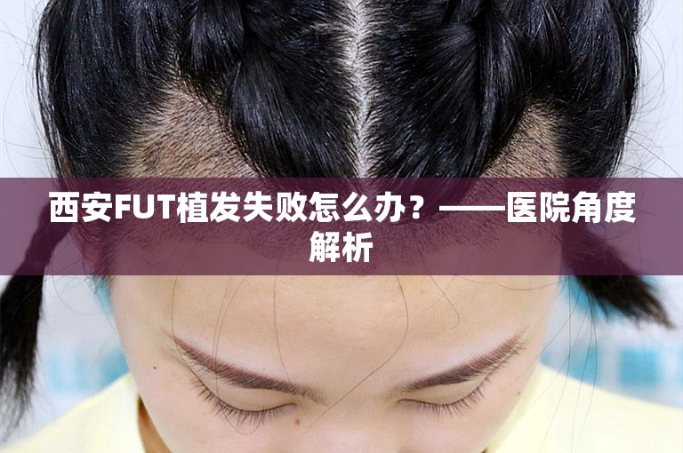 西安FUT植发失败怎么办？——医院角度解析