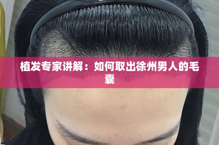 植发专家讲解：如何取出徐州男人的毛囊