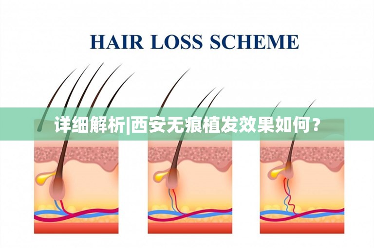 详细解析|西安无痕植发效果如何？