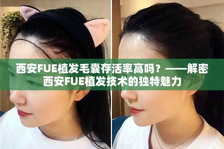 西安FUE植发毛囊存活率高吗？——解密西安FUE植发技术的独特魅力