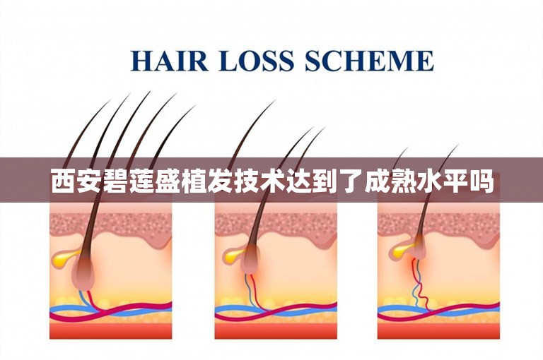 西安碧莲盛植发技术达到了成熟水平吗