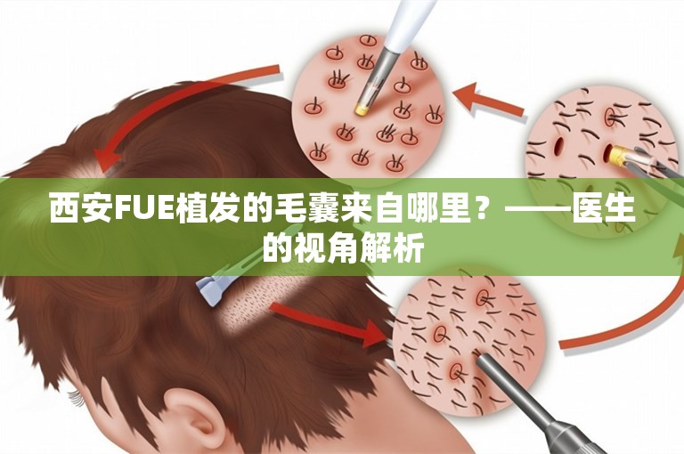 西安FUE植发的毛囊来自哪里？——医生的视角解析