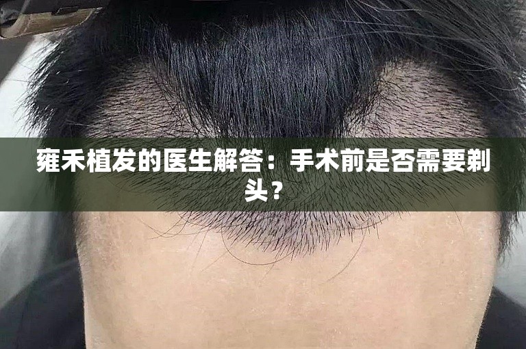 雍禾植发的医生解答：手术前是否需要剃头？