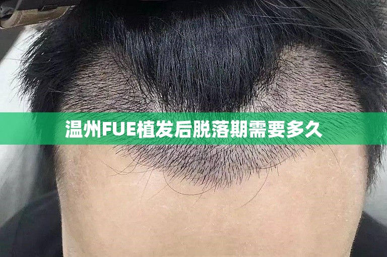 温州FUE植发后脱落期需要多久