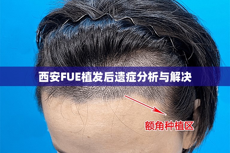 西安FUE植发后遗症分析与解决