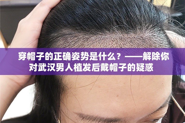  穿帽子的正确姿势是什么？——解除你对武汉男人植发后戴帽子的疑惑 