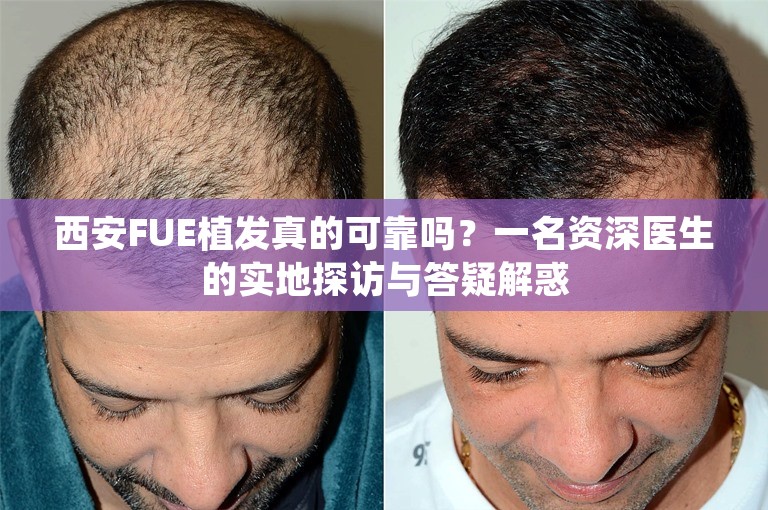 西安FUE植发真的可靠吗？一名资深医生的实地探访与答疑解惑