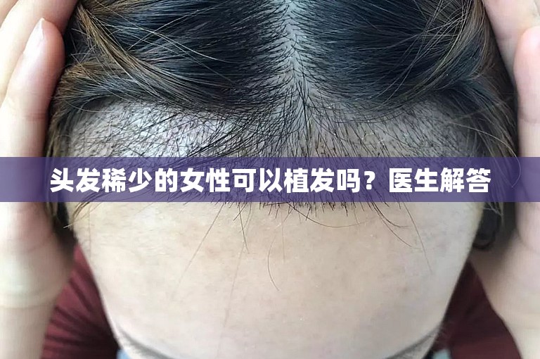 头发稀少的女性可以植发吗？医生解答