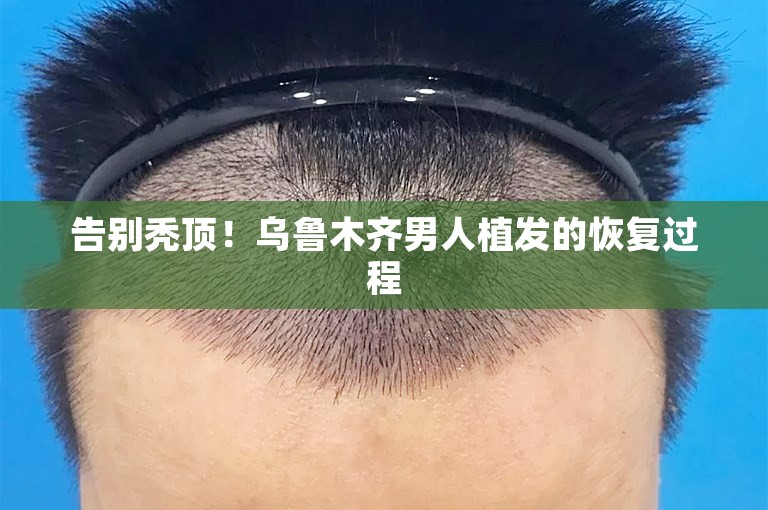 告别秃顶！乌鲁木齐男人植发的恢复过程