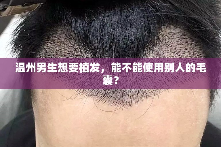 温州男生想要植发，能不能使用别人的毛囊？