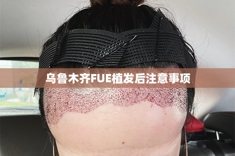 乌鲁木齐FUE植发后注意事项