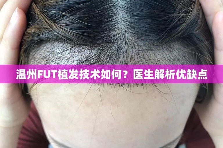 温州FUT植发技术如何？医生解析优缺点