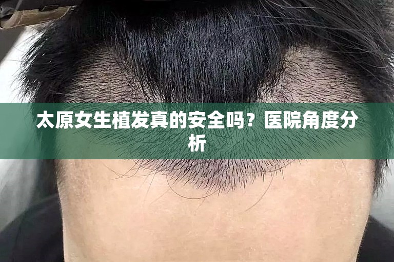 太原女生植发真的安全吗？医院角度分析