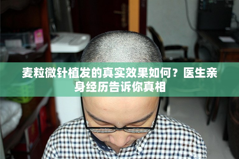 麦粒微针植发的真实效果如何？医生亲身经历告诉你真相