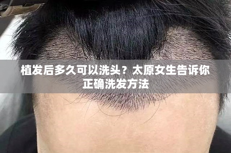 植发后多久可以洗头？太原女生告诉你正确洗发方法