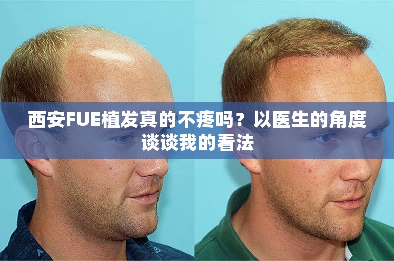 西安FUE植发真的不疼吗？以医生的角度谈谈我的看法