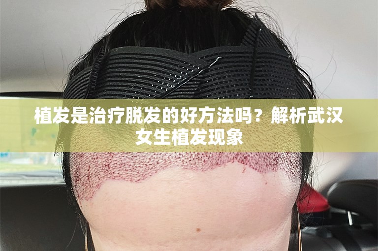 植发是治疗脱发的好方法吗？解析武汉女生植发现象