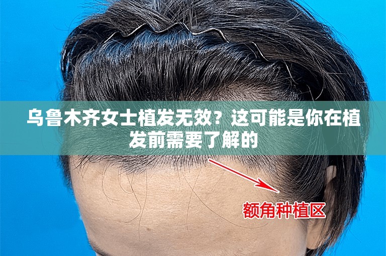 乌鲁木齐女士植发无效？这可能是你在植发前需要了解的