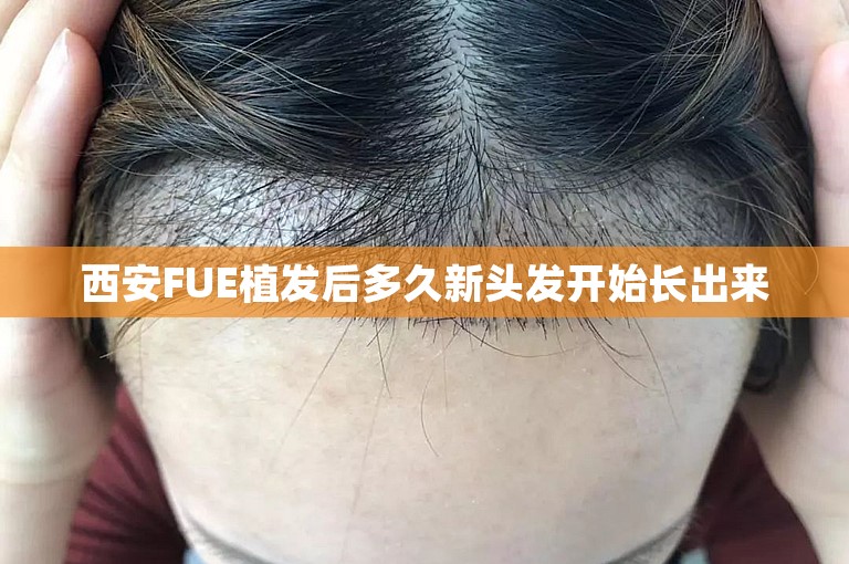 西安FUE植发后多久新头发开始长出来