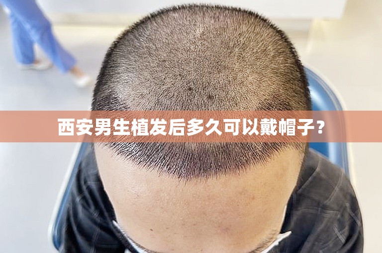 西安男生植发后多久可以戴帽子？