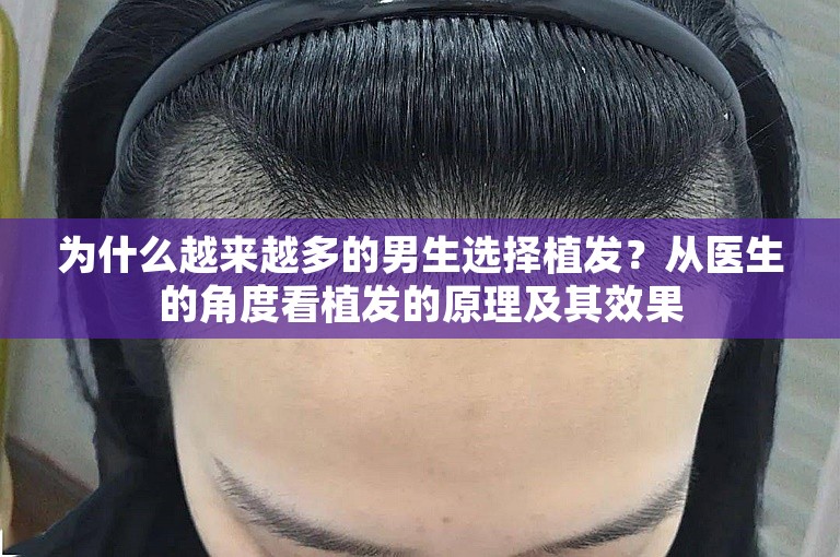 为什么越来越多的男生选择植发？从医生的角度看植发的原理及其效果