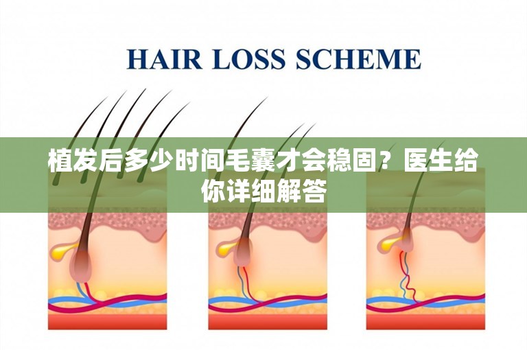 植发后多少时间毛囊才会稳固？医生给你详细解答