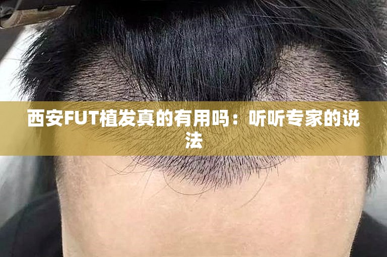 西安FUT植发真的有用吗：听听专家的说法