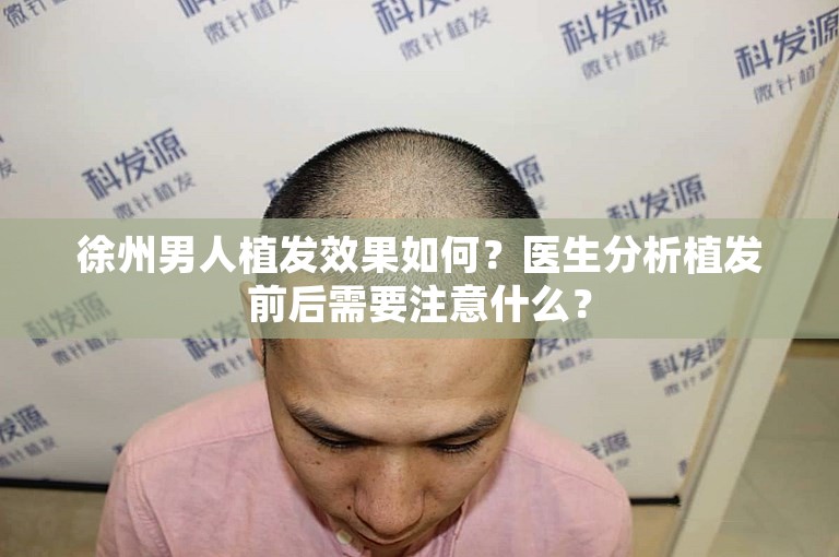 徐州男人植发效果如何？医生分析植发前后需要注意什么？