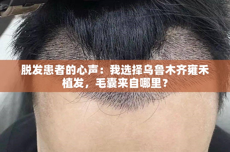 脱发患者的心声：我选择乌鲁木齐雍禾植发，毛囊来自哪里？