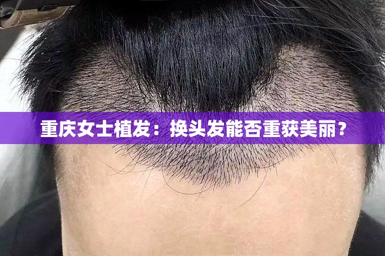 重庆女士植发：换头发能否重获美丽？