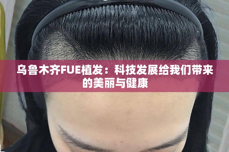 乌鲁木齐FUE植发：科技发展给我们带来的美丽与健康