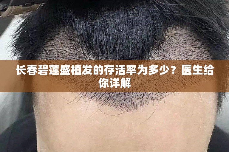 长春碧莲盛植发的存活率为多少？医生给你详解