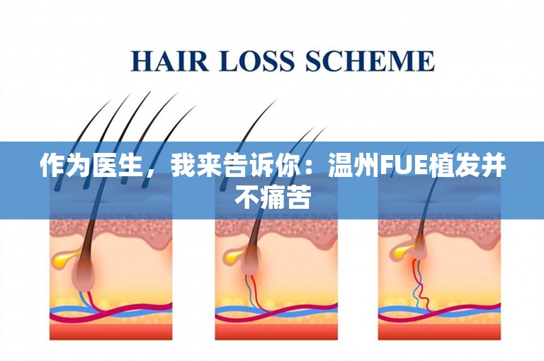 作为医生，我来告诉你：温州FUE植发并不痛苦