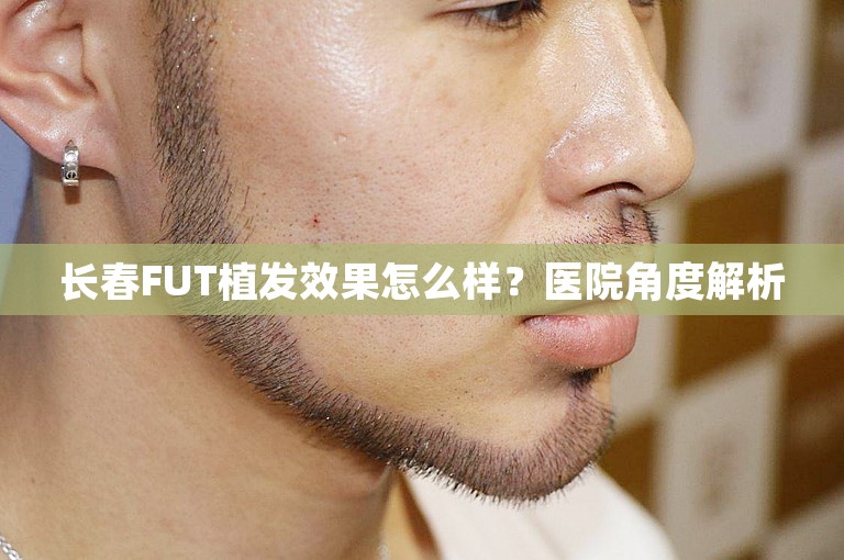 长春FUT植发效果怎么样？医院角度解析