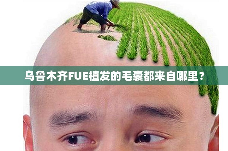 乌鲁木齐FUE植发的毛囊都来自哪里？