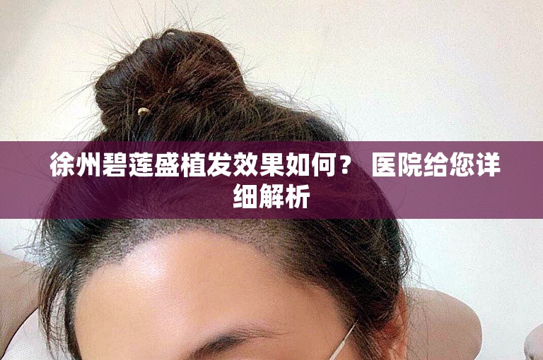  徐州碧莲盛植发效果如何？ 医院给您详细解析