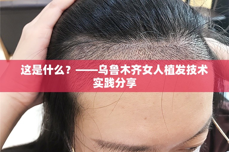 这是什么？——乌鲁木齐女人植发技术实践分享