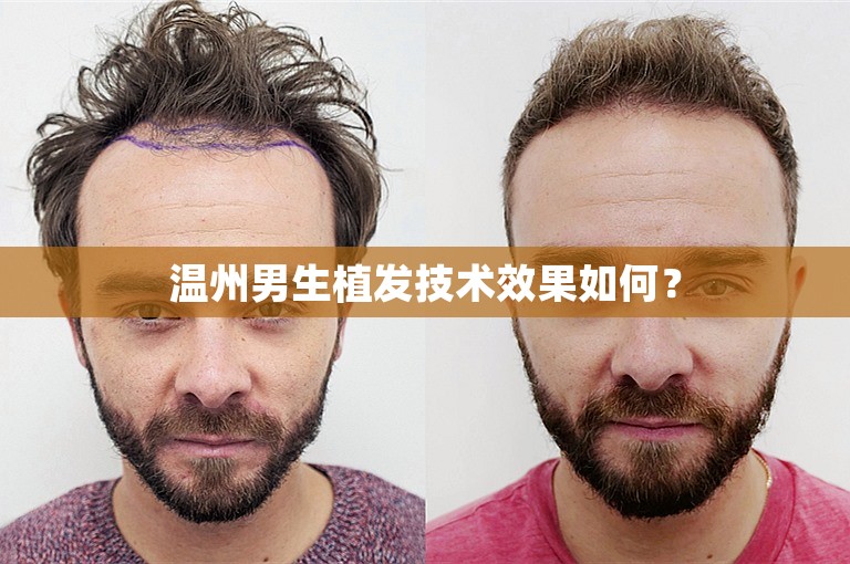 温州男生植发技术效果如何？