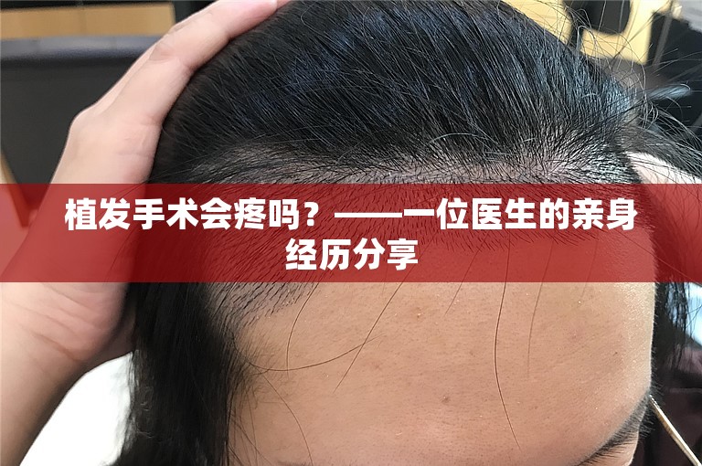 植发手术会疼吗？——一位医生的亲身经历分享